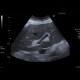 Congestive hepatopathy, biphasic flow in portal vein: US - Ultrasound